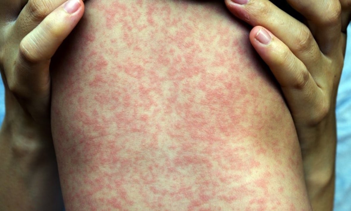 A child's back is covered in splotchy red rashes.